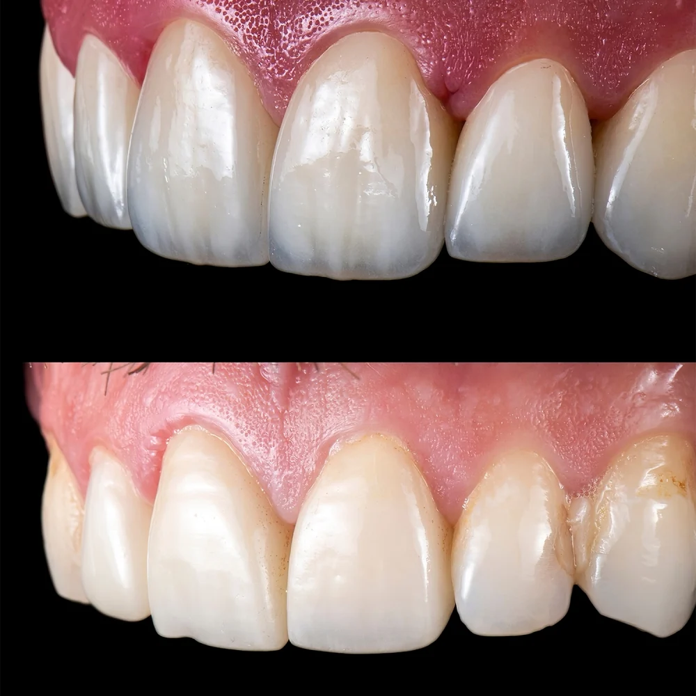 E-Max Veneers
