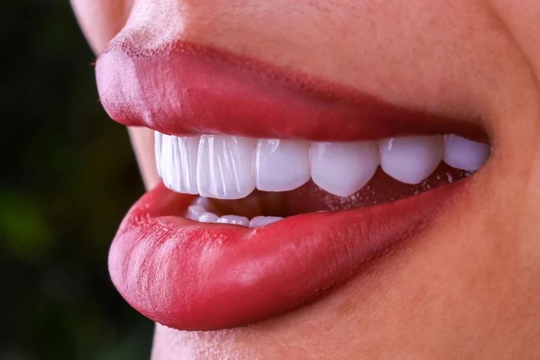 Hollywood Smile Behandlung